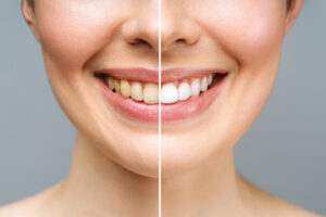 Woman smiling and displaying the difference between whitened and unwhitened teeth