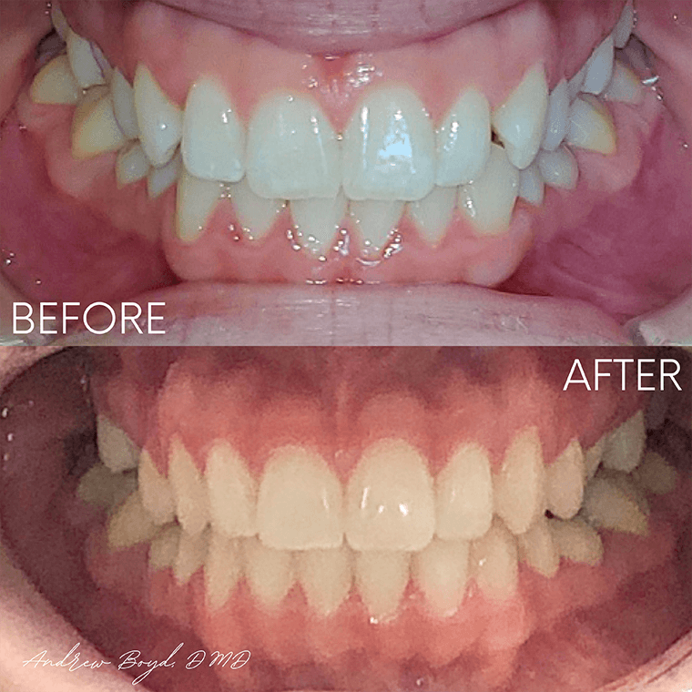 Before and after closeups of a patient with Invisalign
